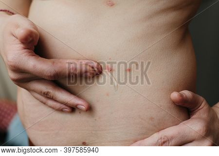 Applying An Emollient To Dry Flaky Skin As In The Treatment Of Psoriasis, Eczema And Other Dry Skin 