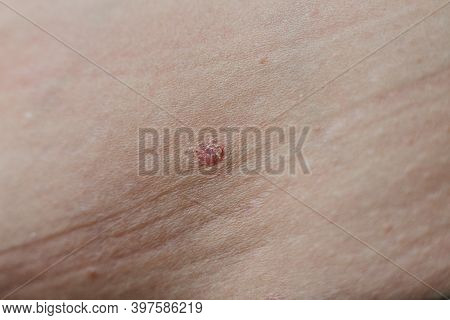 Psoriasis Vulgaris Skin. Psoriasis Is An Autoimmune Disease That Affects The Skin Cause Skin Inflamm