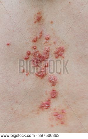 Psoriasis Vulgaris Skin. Psoriasis Is An Autoimmune Disease That Affects The Skin Cause Skin Inflamm
