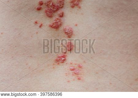 Psoriasis Vulgaris Skin. Psoriasis Is An Autoimmune Disease That Affects The Skin Cause Skin Inflamm