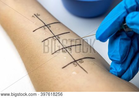Allergist Doing Skin Prick Allergy Test On A Patient Arm Closeup