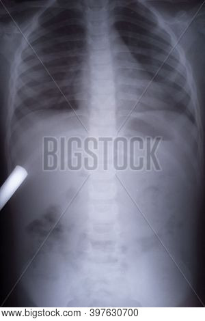 X-ray Picture Of Gas In A Child. Differential Diagnosis Of Intestinal Intussusception In A Child