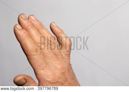 A Human Hand Brush On A Gray Background With Place For Text For Medicine And Traumatology. Ankylosis