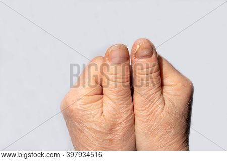 Nail Fungus On The Hands - Dermatomicosis And Onyhomicosis, Comparison Of Healthy And Sick Nails. De