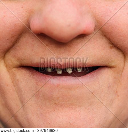 Close-up Of A Womans Face With Rotten And Dying Teeth