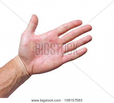 Palm Patient Erythema In Red Spots From Inflammation