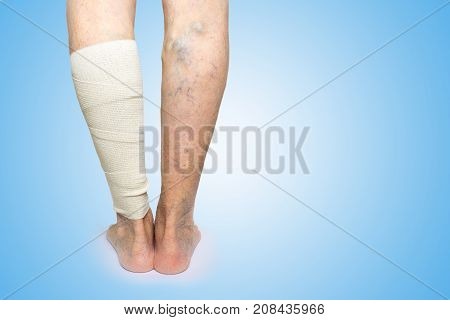 The female legs. Varicose veins. Phlebeurysm. Thrombophlebitis and elastic bandage