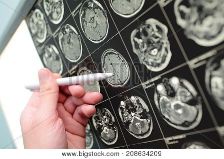 Doctor pointing with pen on the MRI test result.