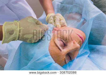 Aged Woman Doing Mesothreads And Thread Lifting, Cosmetology. Cosmetic Procedure To Eliminate Signs 