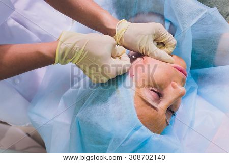 Aged Woman Doing Mesothreads And Thread Lifting, Cosmetology. Cosmetic Procedure To Eliminate Signs 