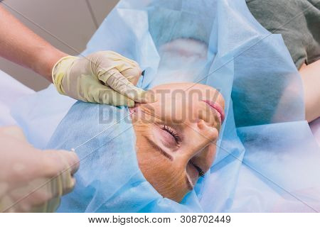 Aged Woman Doing Mesothreads And Thread Lifting, Cosmetology. Cosmetic Procedure To Eliminate Signs 