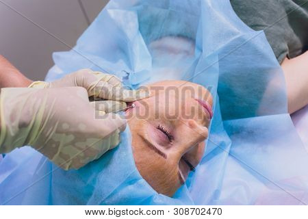 Aged Woman Doing Mesothreads And Thread Lifting, Cosmetology. Cosmetic Procedure To Eliminate Signs 