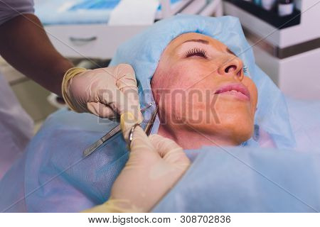 Aged Woman Doing Mesothreads And Thread Lifting, Cosmetology. Cosmetic Procedure To Eliminate Signs 