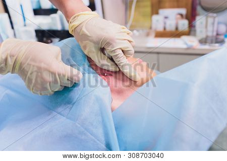 Aged Woman Doing Mesothreads And Thread Lifting, Cosmetology. Cosmetic Procedure To Eliminate Signs 