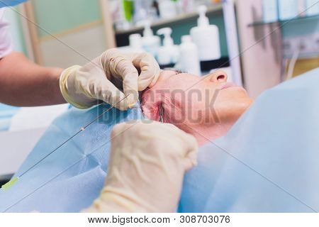 Aged Woman Doing Mesothreads And Thread Lifting, Cosmetology. Cosmetic Procedure To Eliminate Signs 
