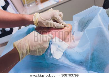 Aged Woman Doing Mesothreads And Thread Lifting, Cosmetology. Cosmetic Procedure To Eliminate Signs 