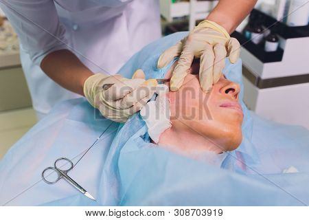 Aged Woman Doing Mesothreads And Thread Lifting, Cosmetology. Cosmetic Procedure To Eliminate Signs 