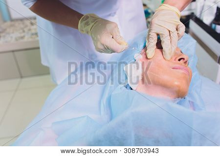 Aged Woman Doing Mesothreads And Thread Lifting, Cosmetology. Cosmetic Procedure To Eliminate Signs 