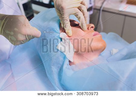 Aged Woman Doing Mesothreads And Thread Lifting, Cosmetology. Cosmetic Procedure To Eliminate Signs 