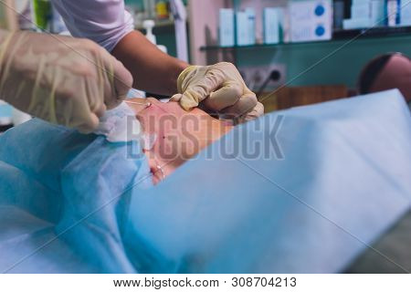 Aged Woman Doing Mesothreads And Thread Lifting, Cosmetology. Cosmetic Procedure To Eliminate Signs 