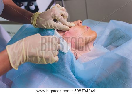 Aged Woman Doing Mesothreads And Thread Lifting, Cosmetology. Cosmetic Procedure To Eliminate Signs 