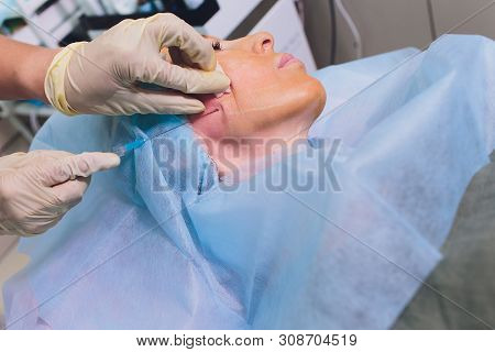 Aged Woman Doing Mesothreads And Thread Lifting, Cosmetology. Cosmetic Procedure To Eliminate Signs 