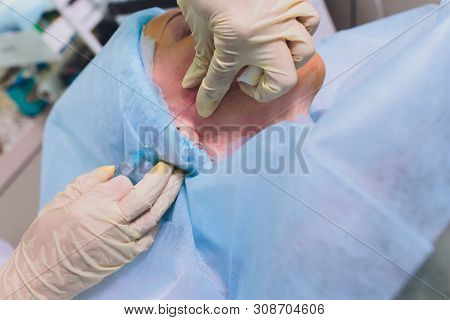 Aged Woman Doing Mesothreads And Thread Lifting, Cosmetology. Cosmetic Procedure To Eliminate Signs 