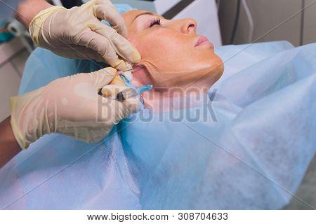 Aged Woman Doing Mesothreads And Thread Lifting, Cosmetology. Cosmetic Procedure To Eliminate Signs 