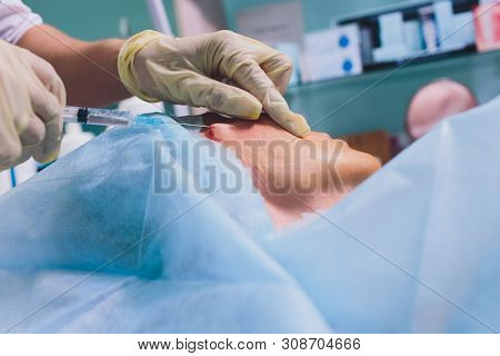 Aged Woman Doing Mesothreads And Thread Lifting, Cosmetology. Cosmetic Procedure To Eliminate Signs 