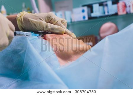 Aged Woman Doing Mesothreads And Thread Lifting, Cosmetology. Cosmetic Procedure To Eliminate Signs 