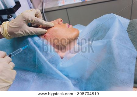 Aged Woman Doing Mesothreads And Thread Lifting, Cosmetology. Cosmetic Procedure To Eliminate Signs 