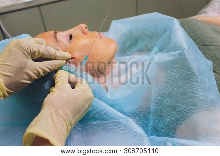 Aged Woman Doing Mesothreads And Thread Lifting, Cosmetology. Cosmetic Procedure To Eliminate Signs 