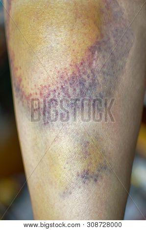 Macro Shot Of Bruise On Skin. Nasty Looking Bruise On Leg