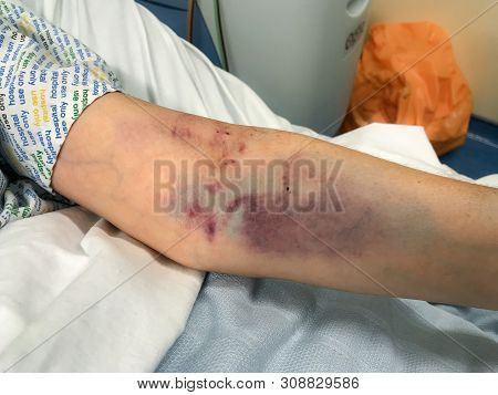 A Close Up Of A Womans Arm Badly Bruised From Several Attempts At Drawing Blood, The Edge Of The Hos