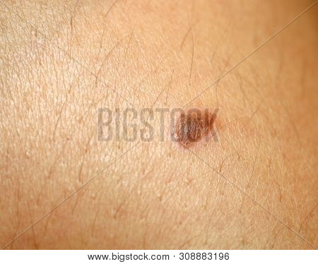 Burn On The Skin. Blister On The Skin