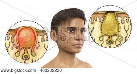 Acne Vulgaris In A Teenager Boy, White And Black Comedo