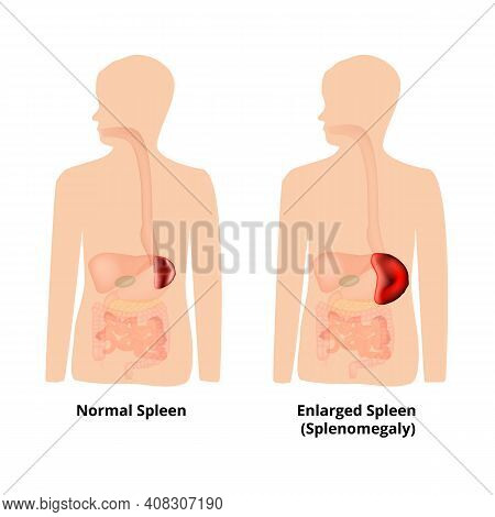 Splenomegaly Of The Spleen. Enlargement Of The Spleen. Illustration On Isolated Background