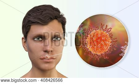 Herpes Labialis, Also Known As Cold Sores, 3d Illustration Showing Lesions On The Man's Lips Caused 