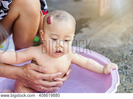 An Adorable Little Child Girl With Big Capillary Strawberry Hemangiomas Red Birthmark On The Head Is