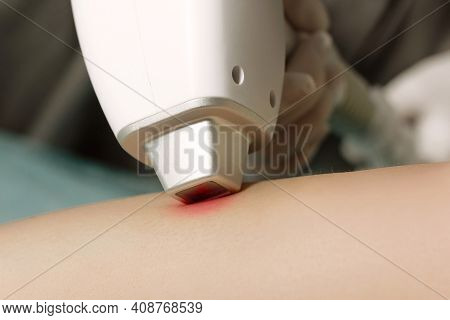 Hair Removal Cosmetology Procedure. Close-up Of Laser Epilation Maniple In Work. Women Health And In