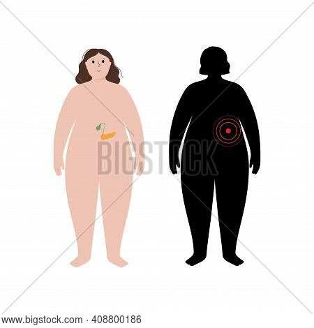 Pain, Inflammation In Pancreas. Adult Obese Woman Anatomy Poster. Diabetes, Ache In Overweight Femal