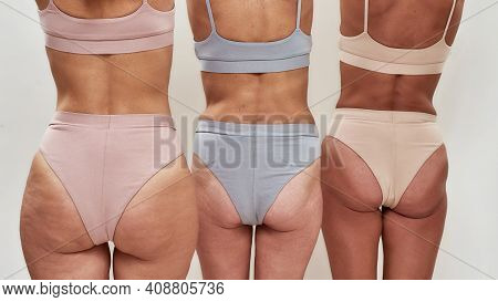 Ladies Displaying Their Backs And Buttoks With Cellulite, Wearing Bras And Underpants On The Naked B