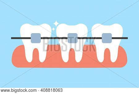 White Teeth With Dental Braces Vector Flat Illustration. Alignment Of Bite Of Teeth. Dental Clinic S