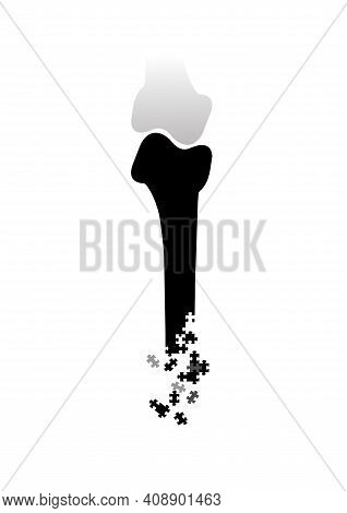 Medical Concept Of Osteoporosis Disease And Other Bone Ailments Vertical Black White Poster Bone Dam