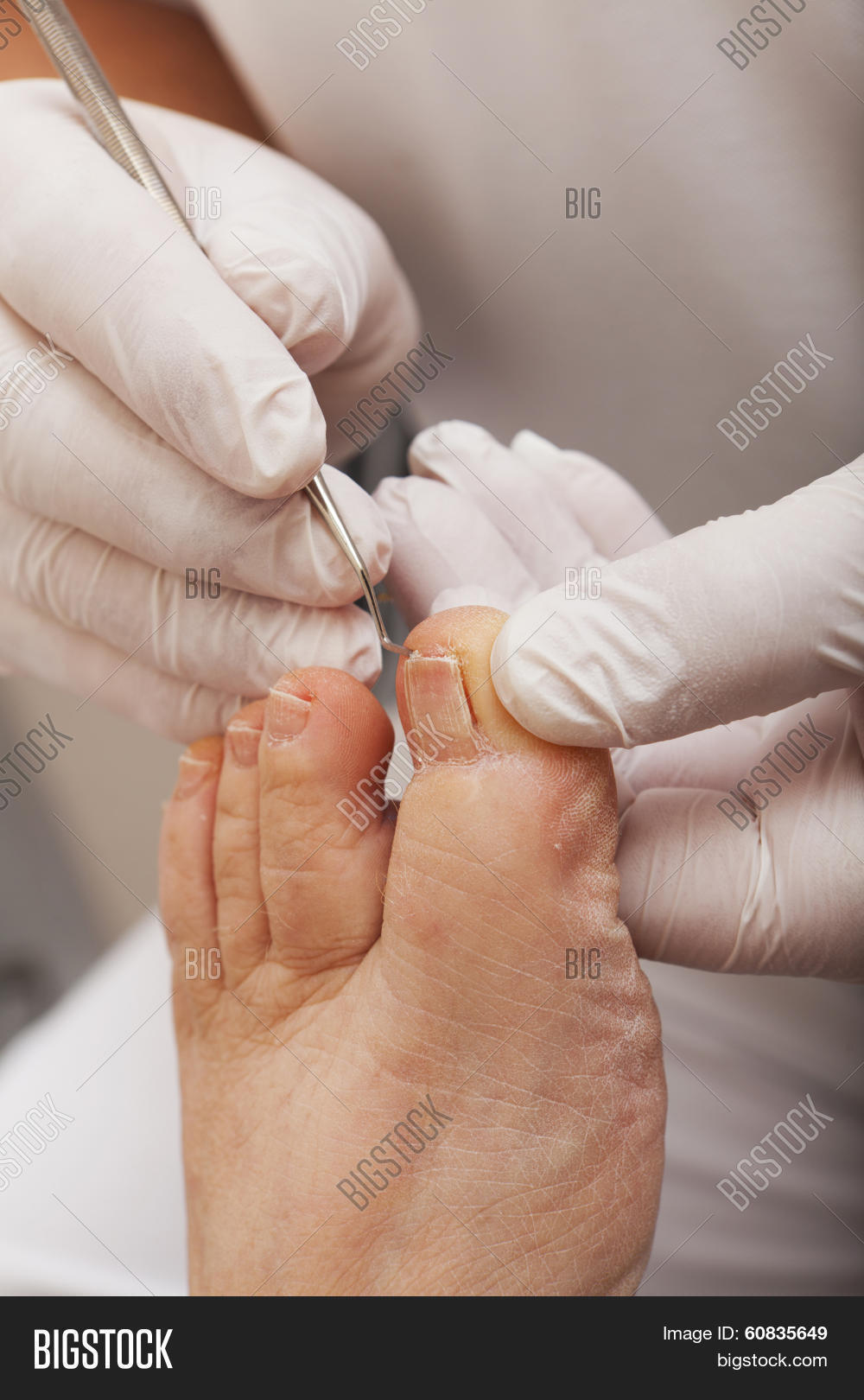 Toenail Lifter Image & Photo (Free Trial) Bigstock