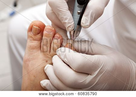 Grind Toenail