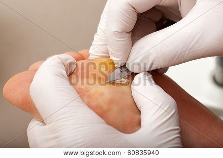 Remove Skin On A Wart With The Scalpel