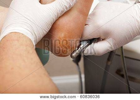 Dry Skin At The Heel