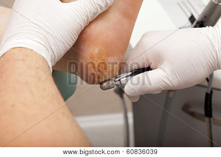 Chiropodists Grinds With A Machine