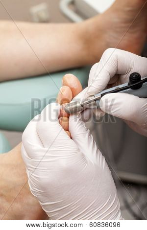 Remove Dry Skin With A Grinder Of A Toe